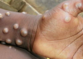 Bangladesh bans shore leave at Chittagong over monkeypox